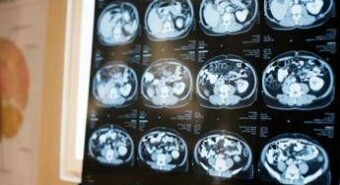 Neurologi: “Noi fondamentali in gestione neoplasie cerebrali”