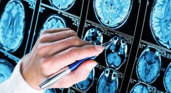 Team italiano scopre nuovo gene coinvolto in malattia Alzheimer