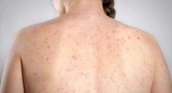 Morbillo, la verità sulla vitamina A: “Non riduce il rischio di contrarre la malattia”