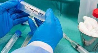 Ricerca, nella saliva 2 spie della demenza a corpi di Lewy, studio Sapienza
