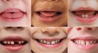 Salute Orale, l’Abc della prevenzione si impara in famiglia