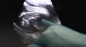 Trapianti, Uk, Amy prima bimba nata da donazione di utero da vivente