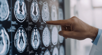 Parkinson, ansia e depressione possono essere segnali precoci: lo studio