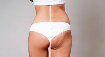 Gambe gonfie e cellulite per 8 donne su 10: la cura riparte dal sistema linfatico