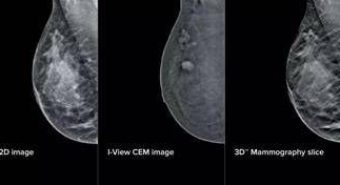 Mammografia ‘intelligente’ al San Camillo di Roma, aiuterà gli specialisti nelle diagnosi