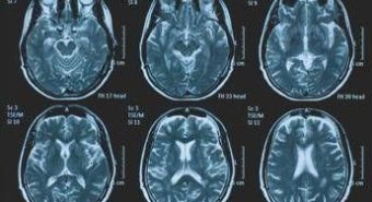 Tumori, glioma pediatrico di basso grado: via libera in Europa a prima terapia mirata