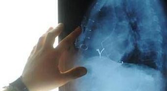 Radiologia interventistica, Ssn e fondazioni per cure più accessibili