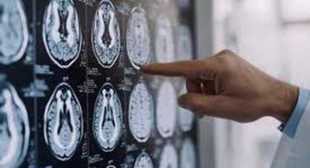 Stop tremori Parkinson senza bisturi, 10 pazienti curati con ultrasuoni a Napoli Stop tremori Parkinson senza bisturi, 10 pazienti curati con ultrasuoni a Napoli